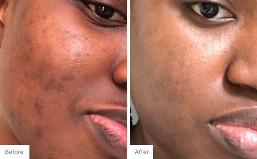 6 - Before and After Real Results photo of a woman's use of Neora's Acne Complexion Treatment Pads