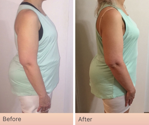 Before and After Real Result pictures of a person who has used the NeoraFit System - 2